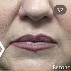 Lip Injections Before & After Patient #16619