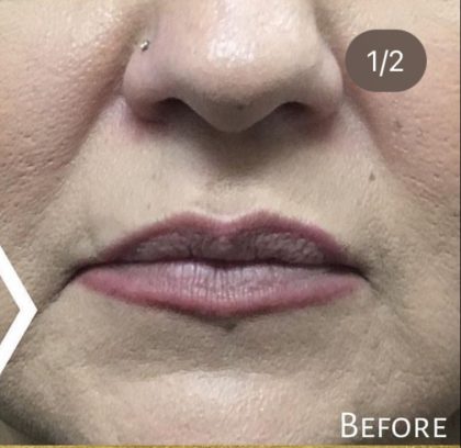 Lip Injections Before & After Patient #16619