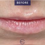 Lip Injections Before & After Patient #16620