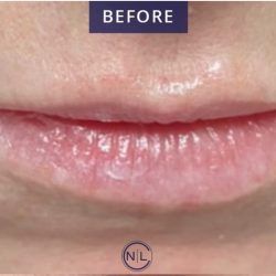 Lip Injections Before & After Patient #16620