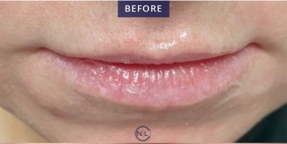 Lip Injections Before & After Patient #16620