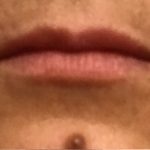 Lip Injections Before & After Patient #16621