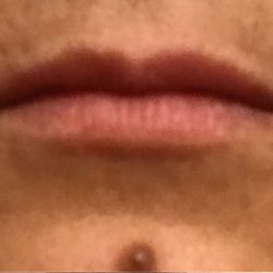 Lip Injections Before & After Patient #16621