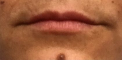 Lip Injections Before & After Patient #16621