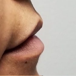 Lip Injections Before & After Patient #16622