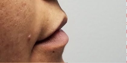 Lip Injections Before & After Patient #16622