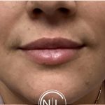 Lip Injections Before & After Patient #16623