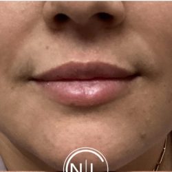Lip Injections Before & After Patient #16623