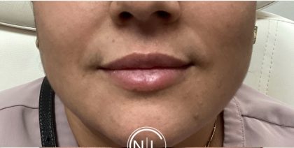 Lip Injections Before & After Patient #16623