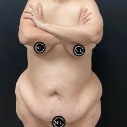 Tummy Tuck Before & After Patient #16527