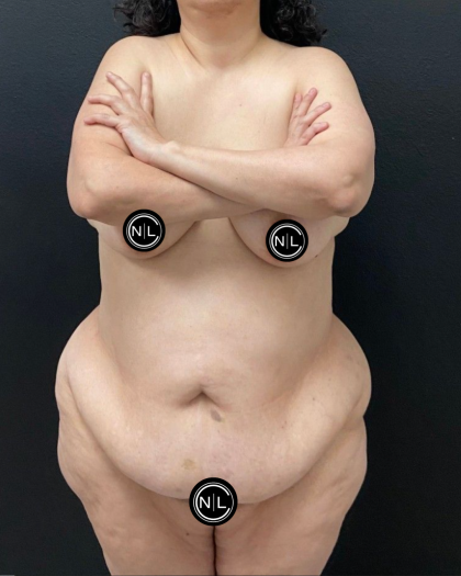 Tummy Tuck Before & After Patient #16527