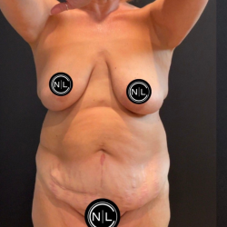 Abdominoplasty Before & After Patient #16563