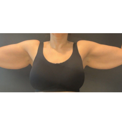 Brachioplasty Before & After Patient #16560