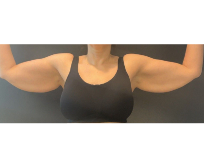 Brachioplasty Before & After Patient #16560