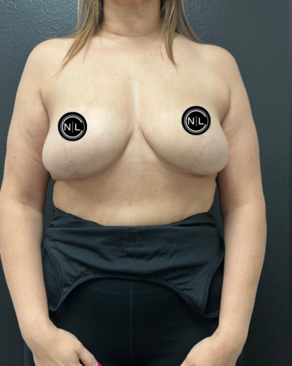 Breast Augmentation Before & After Patient #16528