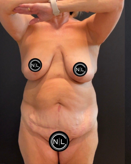 Breast Reduction Before & After Patient #16557