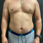 Weight Loss Before & After Patient #16530