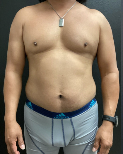 Weight Loss Before & After Patient #16530