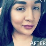 Lip Injections Before & After Patient #16615