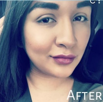 Lip Injections Before & After Patient #16615