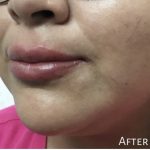 Lip Injections Before & After Patient #16624