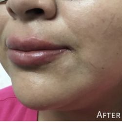 Lip Injections Before & After Patient #16624