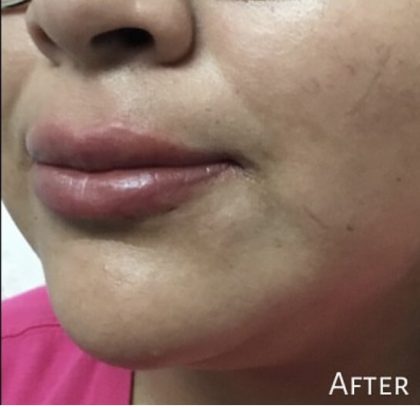 Lip Injections Before & After Patient #16624