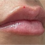 Lip Injections Before & After Patient #16625