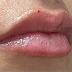 Lip Injections Before & After Patient #16625