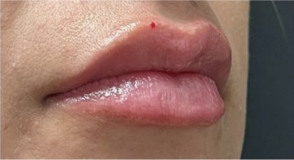 Lip Injections Before & After Patient #16625