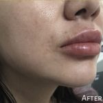 Lip Injections Before & After Patient #16626