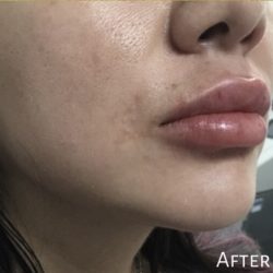 Lip Injections Before & After Patient #16626