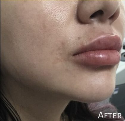 Lip Injections Before & After Patient #16626