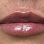 Lip Injections Before & After Patient #16627
