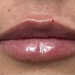 Lip Injections Before & After Patient #16627