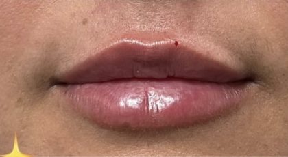Lip Injections Before & After Patient #16627