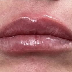 Lip Injections Before & After Patient #16628