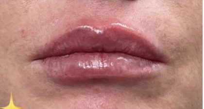 Lip Injections Before & After Patient #16628