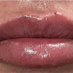Lip Injections Before & After Patient #16629