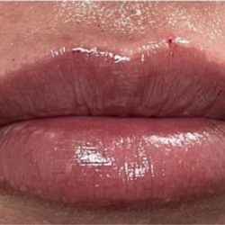 Lip Injections Before & After Patient #16629