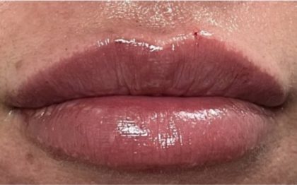 Lip Injections Before & After Patient #16629