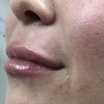 Lip Injections Before & After Patient #16614