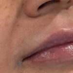 Lip Injections Before & After Patient #16630