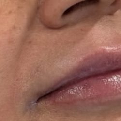 Lip Injections Before & After Patient #16630