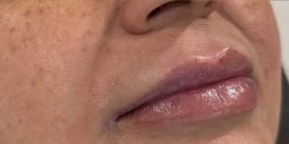Lip Injections Before & After Patient #16630