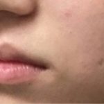 Lip Injections Before & After Patient #16631