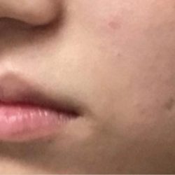 Lip Injections Before & After Patient #16631