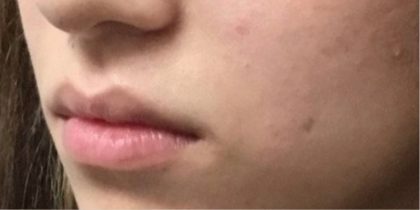 Lip Injections Before & After Patient #16631
