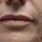 Lip Injections Before & After Patient #16632