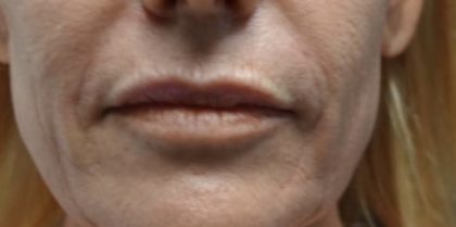 Lip Injections Before & After Patient #16632